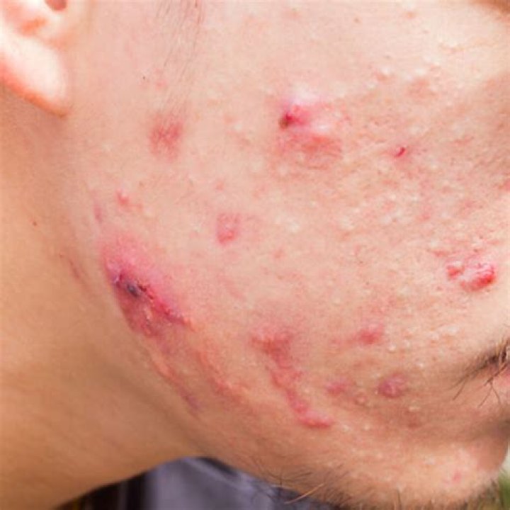 Does triphala help acne?